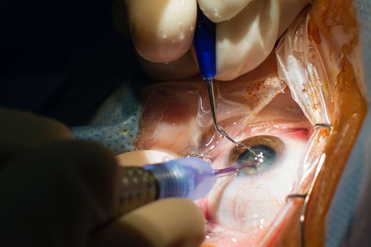 DIF tiene 250 lugares disponibles para cirugías de cataratas 