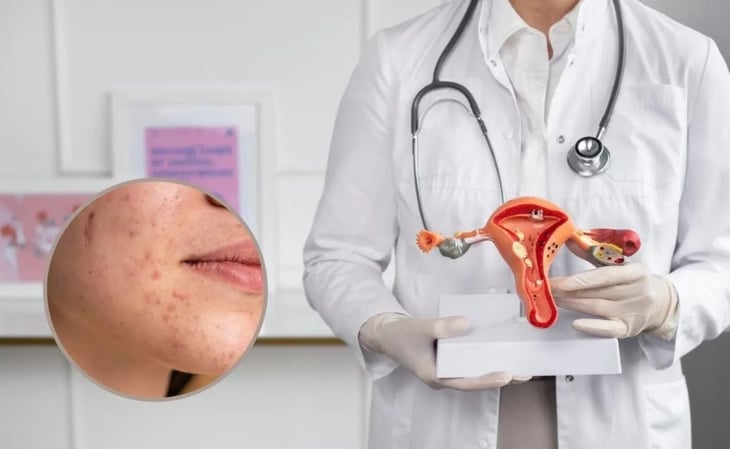 ¿Qué es el Síndrome de Ovario Poliquístico? Enfermedad que muchas mujeres tienen y pocas conocen