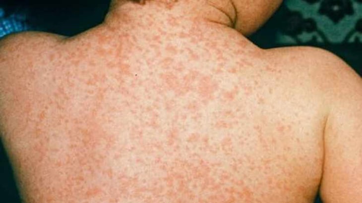 UNAM alerta por nuevo brote de sarampión: ¿Cuáles son sus síntomas y cómo se contagia?
