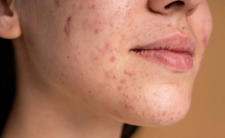 Tratamientos contra el acné podrían ser cancerígenos por contener sustancia peligrosa para la salud