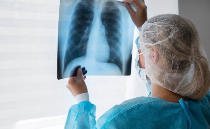 Tratamiento oportuno contra tuberculosis pulmonar cura la enfermedad: INER