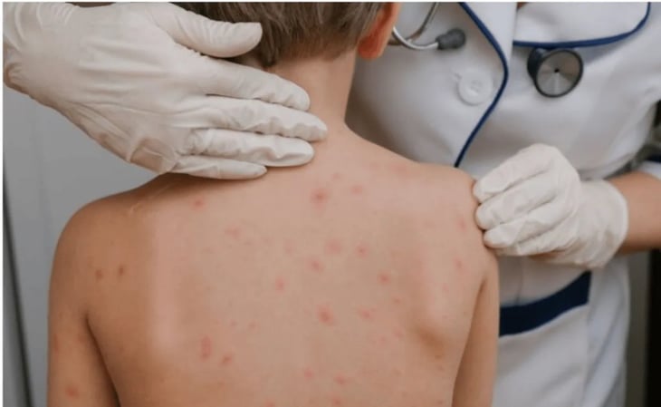 Emite Secretaría de Salud nuevo aviso epidemiológico por cuatro casos de sarampión