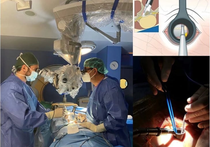 La revolución de la cirugía de la estenosis de columna