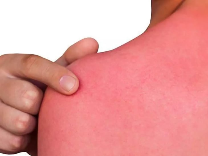 De las quemaduras al melanoma: estos son los posibles efectos del sol en tu piel