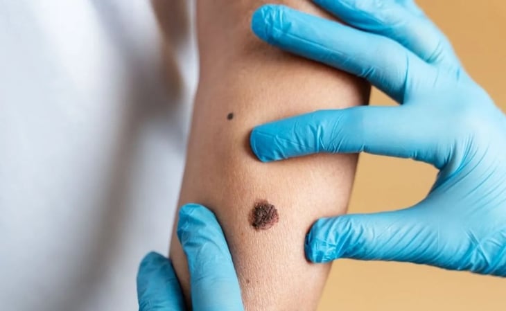 Cofepris autoriza ensayo clínico de vacuna contra cáncer de piel