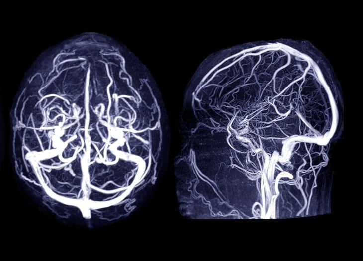 Las estatinas y la metformina pueden reducir las probabilidades de sufrir aneurismas cerebrales