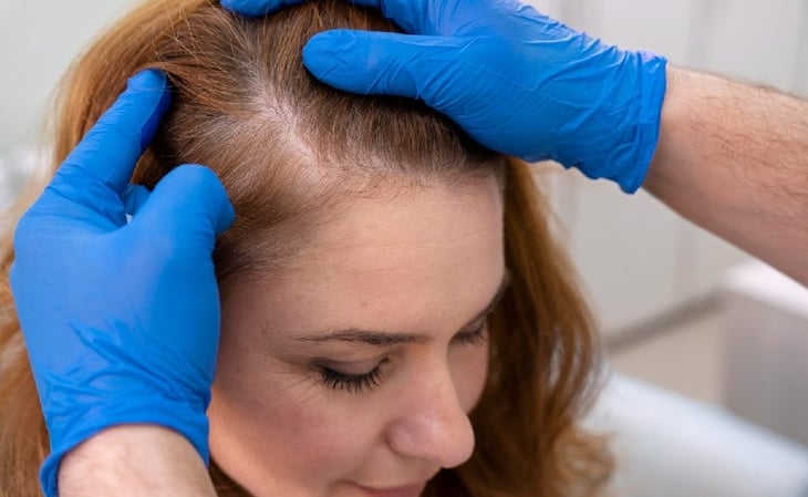 Descubren un gel de azúcar que estimula el crecimiento del cabello: Un avance prometedor contra la calvicie