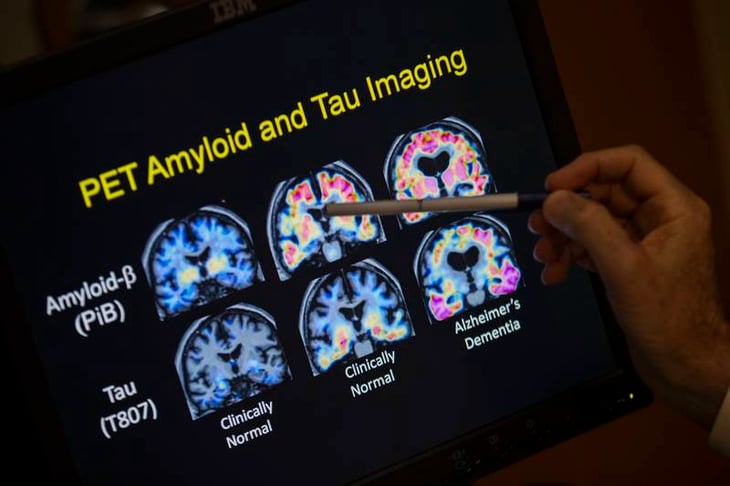 ¿La memoria tiene color rojo? Nuevos analisis de sangre detectarán más rápido casos de Alzheimer