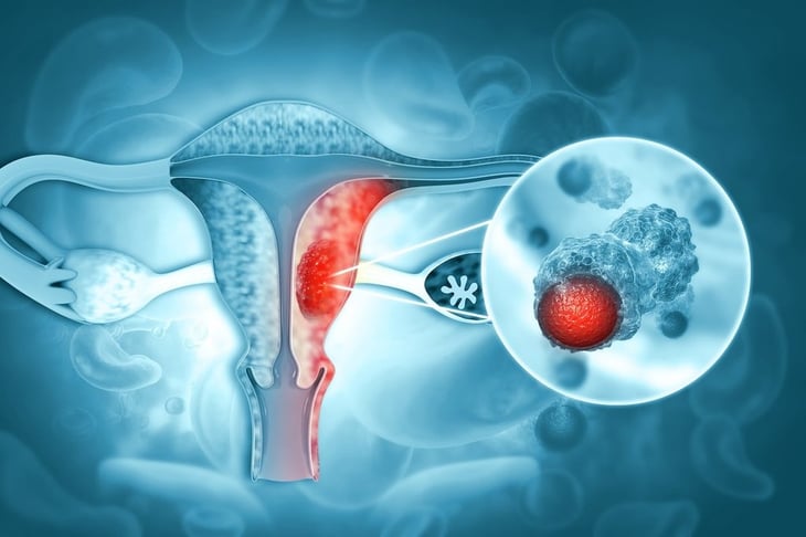 Muchas mujeres no conocen esta señal de advertencia del cáncer de endometrio