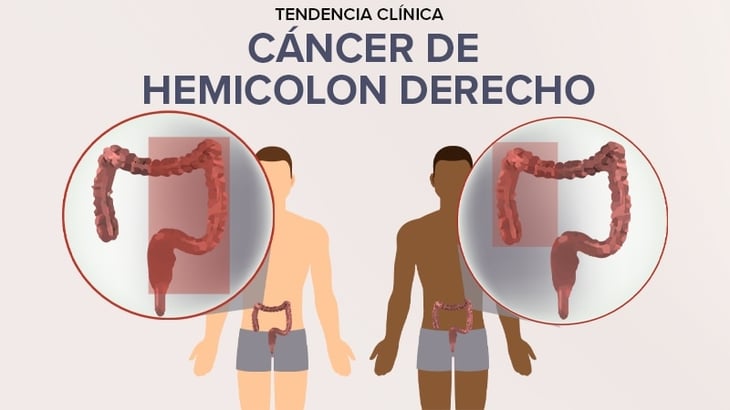 Columbia-1: resultados de un estudio en cáncer colorrectal