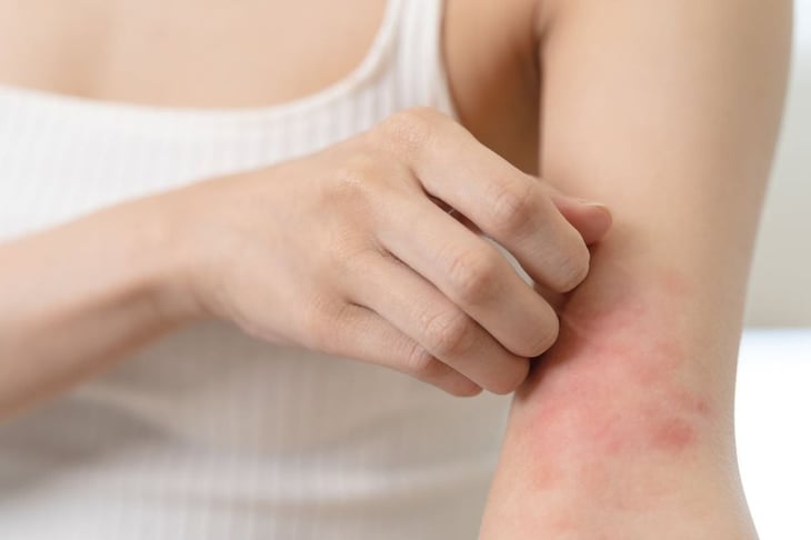 Los niños obesos podrían tener mayores probabilidades de eccema y psoriasis