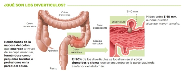 Reconoce los síntomas de los divertículos, la afección más frecuente del colon