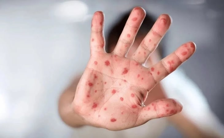 México suma 61 casos de viruela del mono o mpox; Sonora y Veracruz, focos de contagio