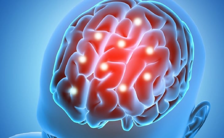 ¿Qué es un infarto cerebral?: 6 señales de alerta que no debes ignorar