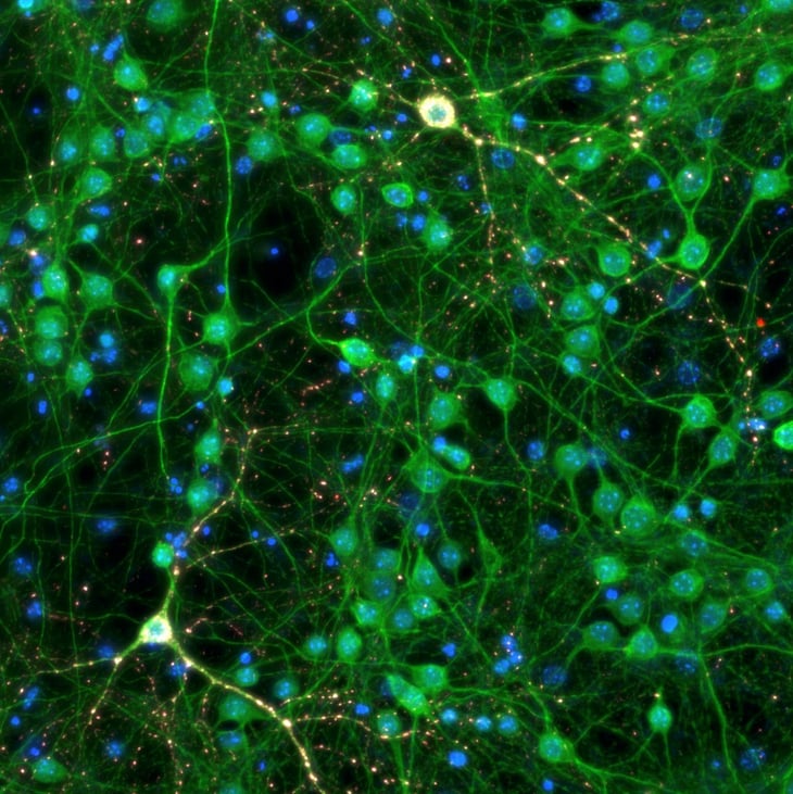 Una terapia ataca y destruye ovillos de una proteína clave en alzhéimer