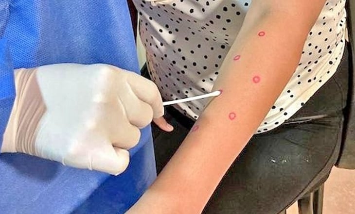 Detectan primer caso de Mpox en Morelos