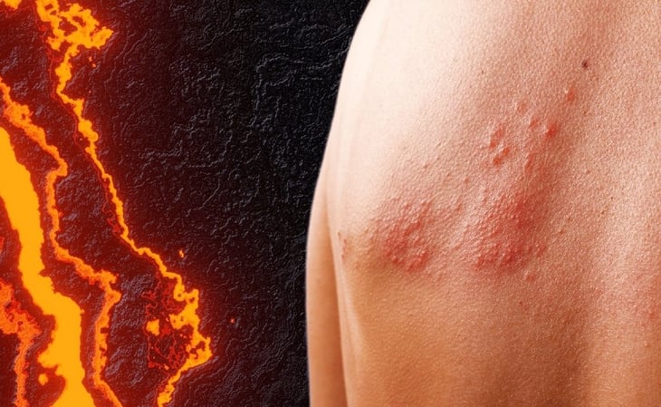 El dolor del herpes zóster podría compararse con dar a luz o un infarto