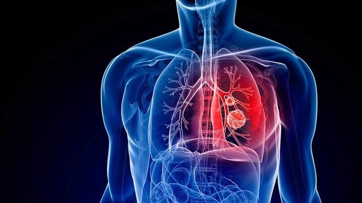 Obstáculos para tratar el cáncer de pulmón mediante células T con receptores de antígenos quiméricos