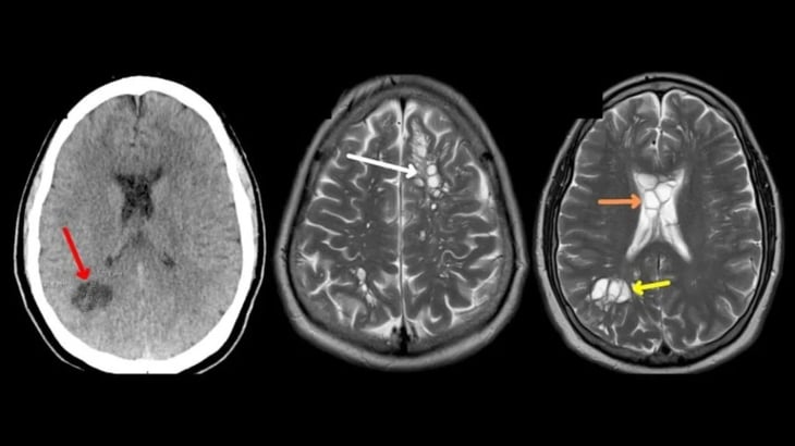 Descubren que las fuertes migrañas de este hombre eran por larvas de tenia en su cerebro