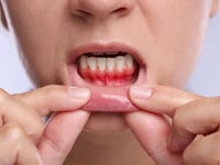 La enfermedad de las encías puede aumentar el riesgo de accidente cerebrovascular