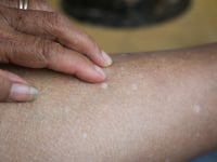 Hongos, sol o déficit de vitaminas: por qué salen manchas blancas