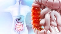 Cáncer de colon: síntomas iniciales clave para la detección temprana