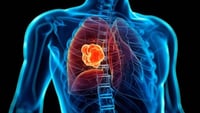 ¿Qué es el mesotelioma, tipo de cáncer que recubre tejidos de órganos?