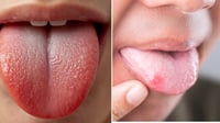 ¿Por qué aparecen puntos rojos en la lengua? Lo que puede indicar sobre la salud