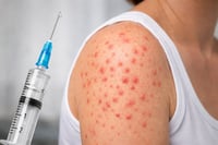 ¿Por qué el sarampión es más infeccioso que el COVID-19?