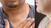 ¿Qué pasa si elimina las verrugas del cuerpo con un cabello o un hilo?