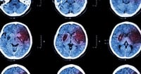 Derrame cerebral: 9 señales de alerta que pueden salvar tu vida