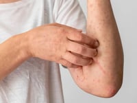 Alerta Sanitaria en México: El Brote de Sarampión suma más de 8,000 casos