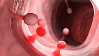 Pólipos en el colon: No ignores estas señales de alerta