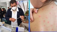 Quiénes son las personas que no deben recibir la vacuna de sarampión 