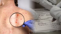 ¿Crees que es gripe? Podría tratarse de sarampión: Estos son los primeros síntomas