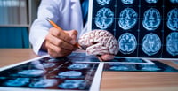 Alzheimer, una carrera contra el tiempo