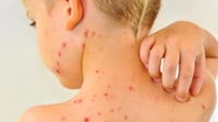 Sarampión pega más a niños de 1 a 4 años