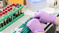 Análisis de sangre estima cuándo comenzarán los síntomas del Alzheimer