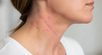 Dermatitis atópica: cómo prevenir los brotes de eczema