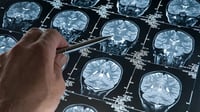 Estudio de sangre predice inicio de síntomas del Alzheimer