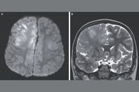 Así se ve un cerebro destruido por el sarampión