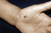 Esas manchas negras en tus manos podrían ser cáncer de piel: ¿Qué sabemos del melanoma acral?