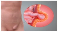 Qué es la hernia inguinal y cuáles son los síntomas más comunes