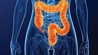 El cáncer de colon es el más mortífero entre los adultos jóvenes