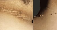 Verrugas en el cuello y manchas: 9 señales físicas de alerta metabólica