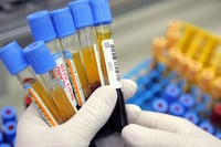 Sugieren que un simple análisis de sangre puede predecir el deterioro cognitivo