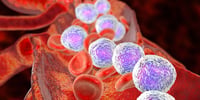 Una prueba genética puede predecir el riesgo de recaída de leucemia