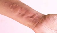La urticaria crónica no es solo un problema de piel: cómo impacta en el sueño, la ansiedad