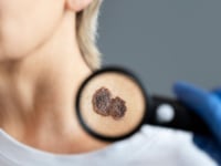 5 señales para detectar un lunar peligroso y prevenir el cáncer de piel