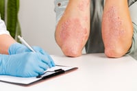Nueva píldora podría cambiar el tratamiento de la psoriasis